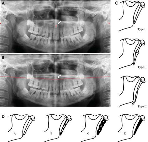 Styloid Process X Ray