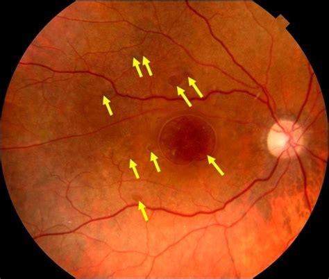 Multiple Retinal Holes - Retina Image Bank