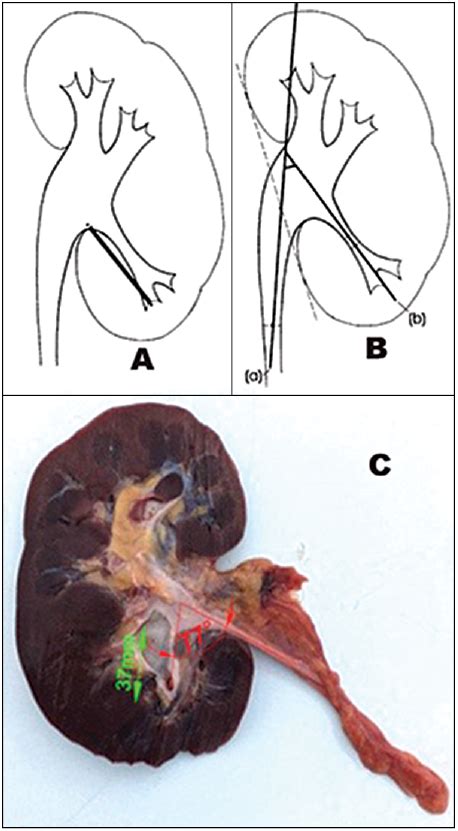 The evaluation of morphology of renal pelvicalyceal system’s and infundibulopelvic anatomy of ...