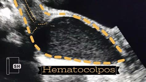 Hematocolpos - YouTube