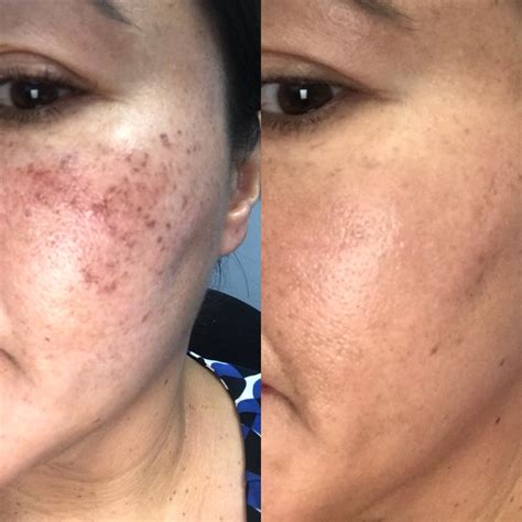 Managing Acne Scars With Sublative Rejuvenation - Tarzana & Encino