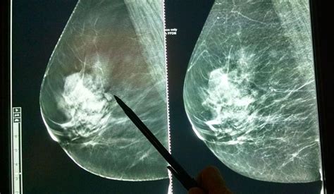 3D Mammograms among many diagnostic tools available | Health | herald ...