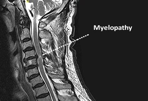 Numbness After Accident (Myelopathy) - Myelopathy is nerve damage ...