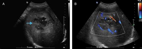 The Evolving Nature of Hepatic Abscess: A Review