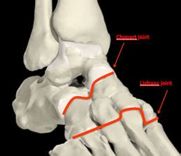 Midfoot Arthritis Treatment | Private Surgeon London | London Foot and Ankle