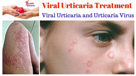 Viral Urticaria Treatment - Viral Urticaria and Urticaria Virus 😉 - YouTube