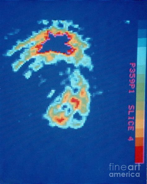 Pet Scan Of Human Heart With Blood Clot Photograph by Science Source