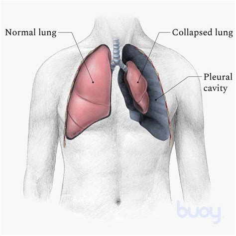 Punctured Lung (pneumothorax): Symptoms, Treatment, And, 57% OFF