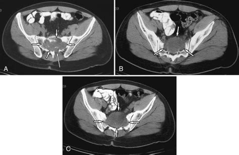 Giant Cell Tumor | Radiology Key