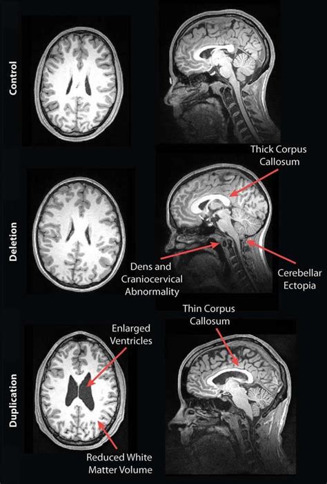 What Can Brain Mri Show - BRAINLY CGW