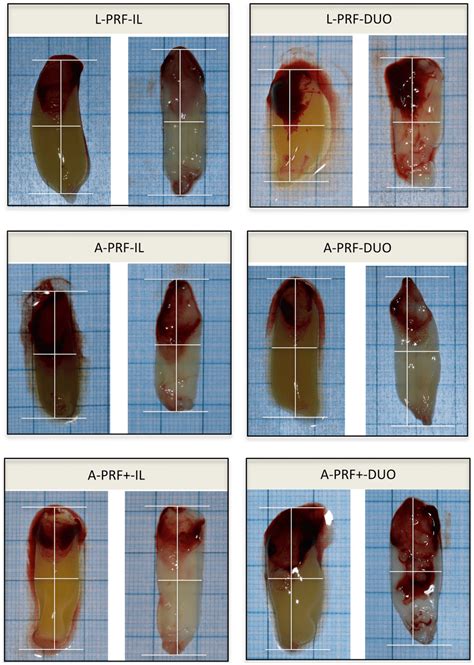 Standardized pictures and measurements of the clots and membranes. The... | Download Scientific ...