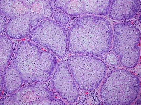 Sebaceous Adenoma - The Clinical Advisor