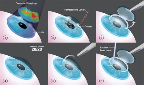 Lasik / Femto Lasic procedure advantages and disadvantages & it's More