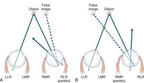 Diplopia (Double Vision) Physiological and pathological - Optography