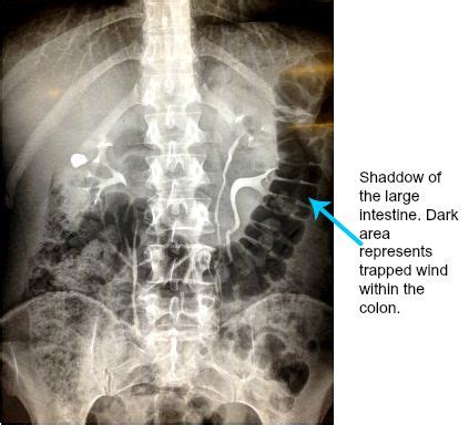 Causes of Trapped Wind, Diagnosis & Treatment | ABDOPAIN.com