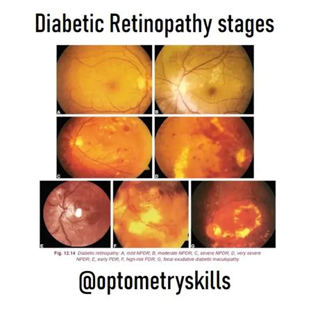 Diabetic Retinopathy stages - An Eye Care Blog