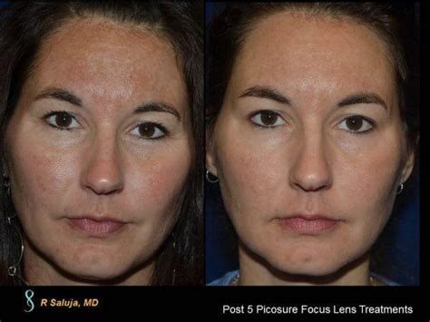 Melasma Treatment Before & After - Charlotte Huntersville, NC: Saluja ...