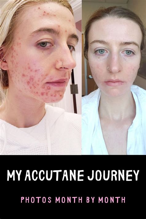 MY ACCUTANE JOURNEY I Before & After Photos of Acne & Clear Skin | Dry skin treatment, Accutane ...