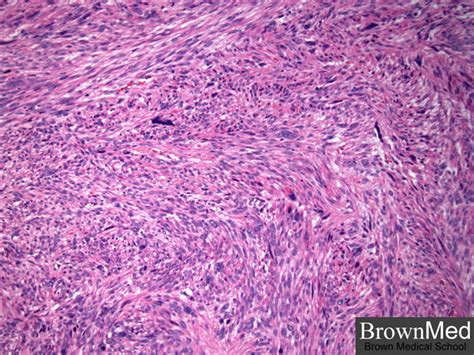 Leiomyosarcoma; Leiomyosarcoma, Epithelioid; Leiomyosarcoma, Myxoid