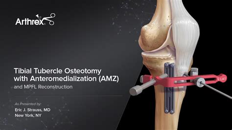 Arthrex - Tibial Tubercle Osteotomy