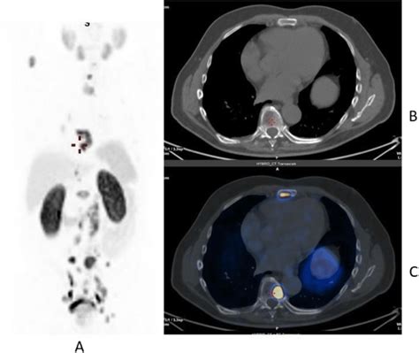 ⁶⁸Ga-PSMA, prostate cancer, staging. Clinical history: 56 y.o. man with ...