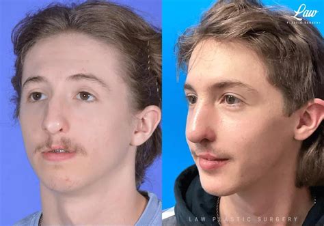 Jaw Surgery (LeFort 1, BSSO, Genioplasty), Cleft Rhinoplasty - Before and After : r/PlasticSurgery