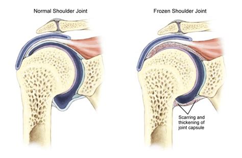 What Causes Frozen Shoulder, and the Most Effective Treatment