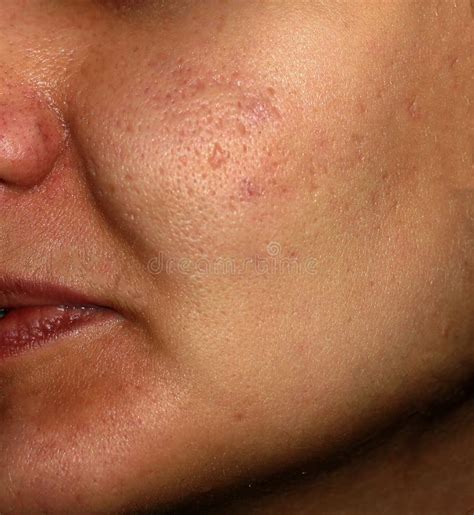 Inflamed Skin of the Face in Pimples and Acne. Keloid Scars from Acne Stock Image - Image of ...