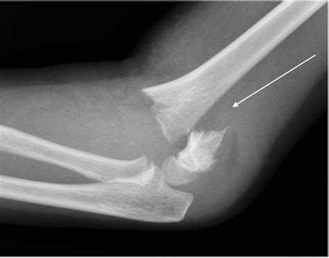 Cureus | Epidemiological Analysis of Displaced Supracondylar Fractures