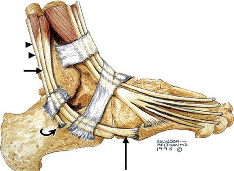 MRI Musculo-Skeletal Section: Peroneal tendon lesions.