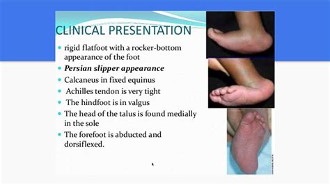 Congenital Vertical Talus for medical students - YouTube