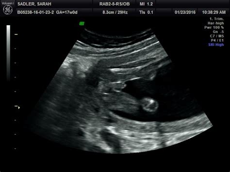 17 weeks ultrasound. For sure a boy? - BabyCenter