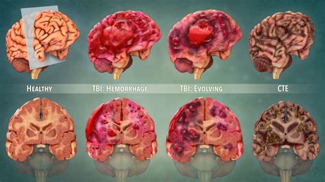 Cte Brain Compared To Normal Brain : Mri Of Truamatic Brain Injury By Dr David J Mikulis Youtube ...