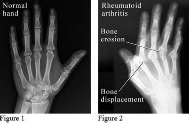 RHEUMATOID ARTHRITIS. Bagian II