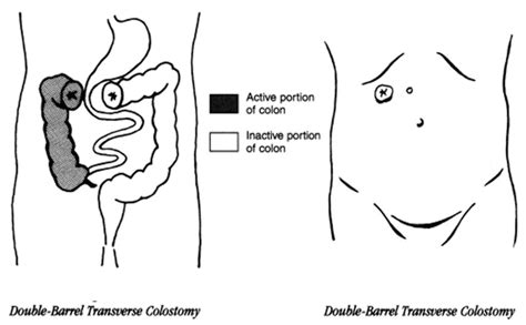 Colostomy - How To Change A Colostomy Bag & Living With It