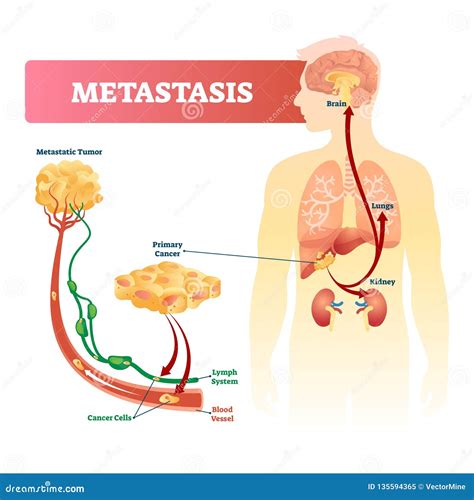 Metastasis Diagram