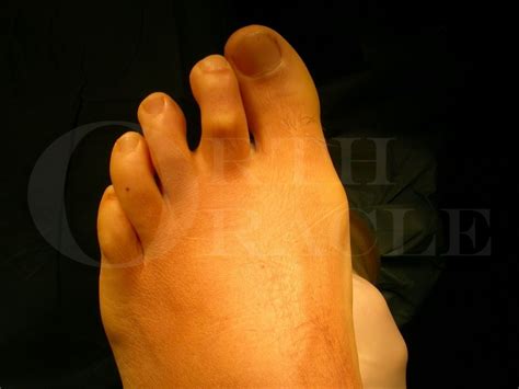 Crossover second toe deformity: Extensor Digitorum Brevis transfer Surgical Technique - OrthOracle