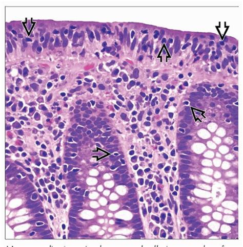 Lymphocytic Colitis | Basicmedical Key