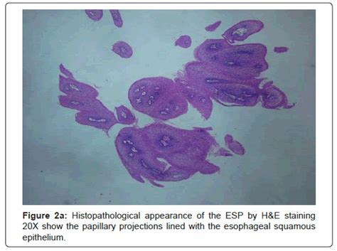 gastrointestinal-digestive-papillary-projections-lined