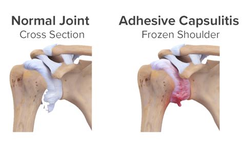 FROZEN SHOULDER: WHAT IT IS? Diasurge Medical