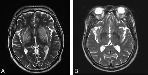 Uremic Encephalopathy Pathophysiology, symptoms & Management