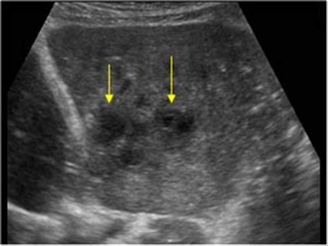 Abdomen and retroperitoneum | 1.1 Liver : Case 1.1.6 Liver abscesses | Ultrasound Cases