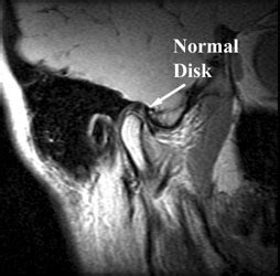 TMJ Imaging - Imaging Glossary - Patients - UR Medicine Imaging ...