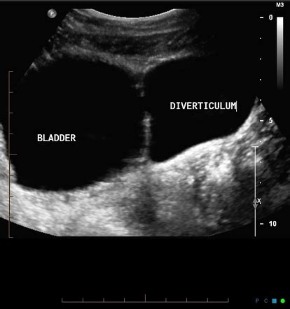 MRI artifact (flow void between urinary bladder and bladder diverticulum) | Image | Radiopaedia.org