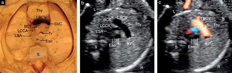 Fetal left brachiocephalic vein in normal and abnormal conditions ...