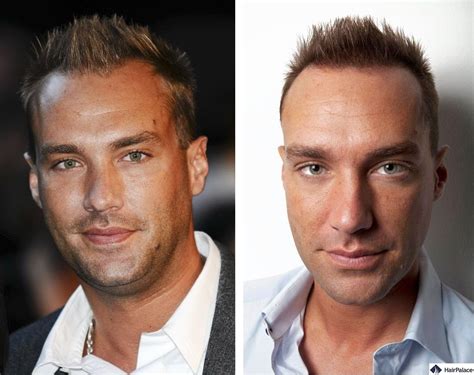 Calum Best's hair transplant journey: Decisions, surgeries, costs