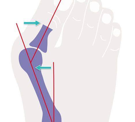 Hallux valgus – causes, symptoms and surgical treatment – Healthy Food Near Me