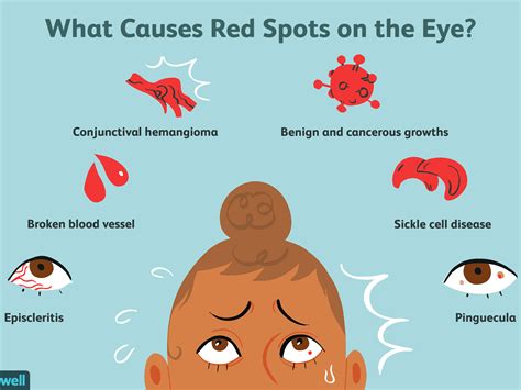 What Causes Red Flashing Lights In Eyes | Americanwarmoms.org