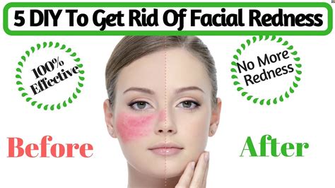 Natural Tips To Get Rid Of Facial Redness | How to Cure Red, Irritated Skin | AVNI - YouTube