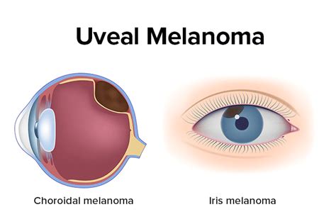 Ocular Melanoma - All About Vision